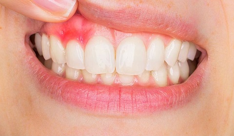 Dişeti Hastalıkları